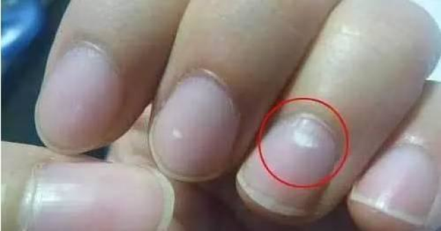 赶快看看你的手指甲上有没有黑线 小心得这种病图片