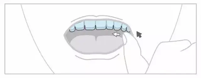 隐形牙套 | 这套究竟怎么戴/摘?