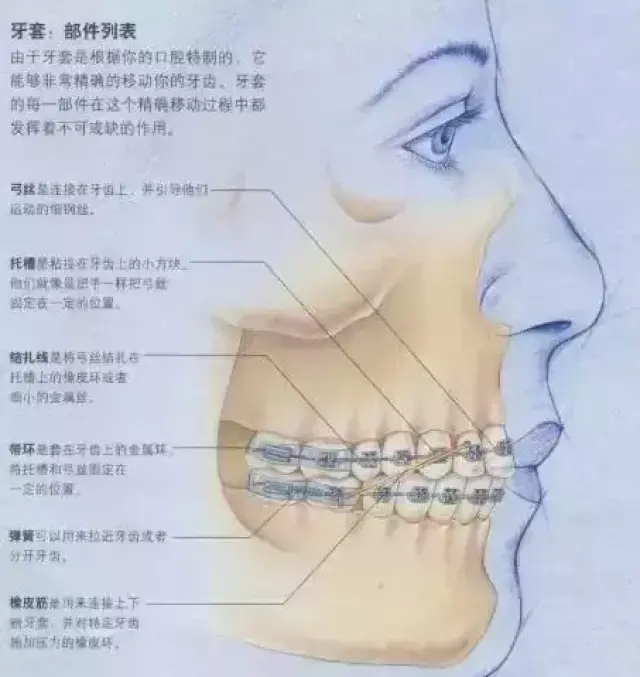 牙齿的移动:弹性弓丝施加的压力,就像是火车头一样沿着轨迹来引导牙齿
