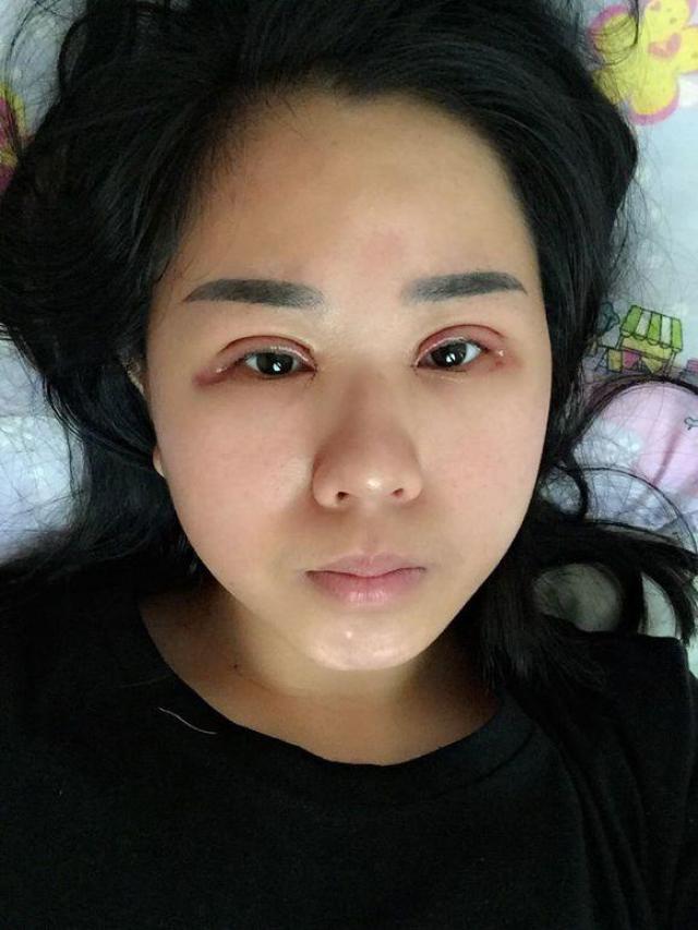 全切双眼皮 开眼角,不消肿啊不消肿,烦啊烦啊