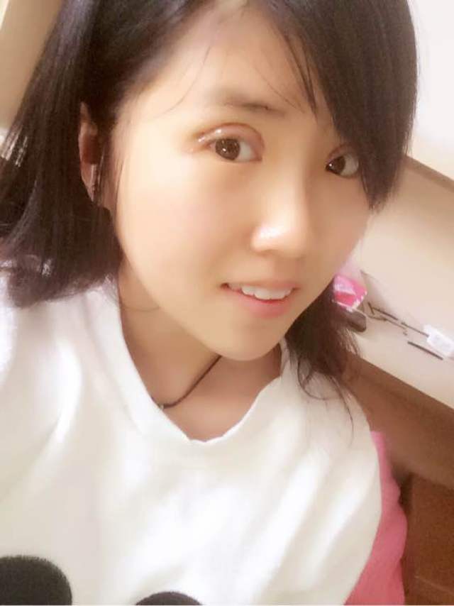 全切双眼皮 去皮去脂,做的是平行的,怎么样