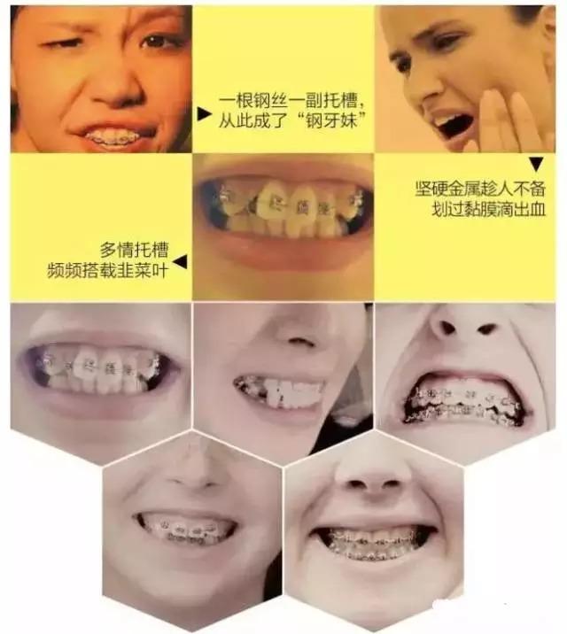 传统矫正 钢丝牙齿,托槽绑架口腔.