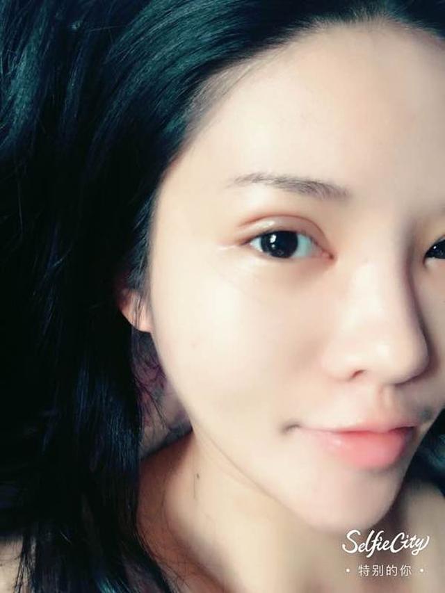 全切双眼皮 开眼角,一个多月恢复过程图分享