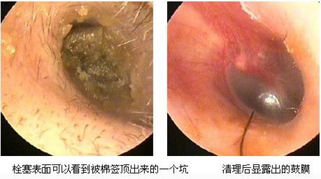 棉签掏耳屎?看你掏出来的都是啥?