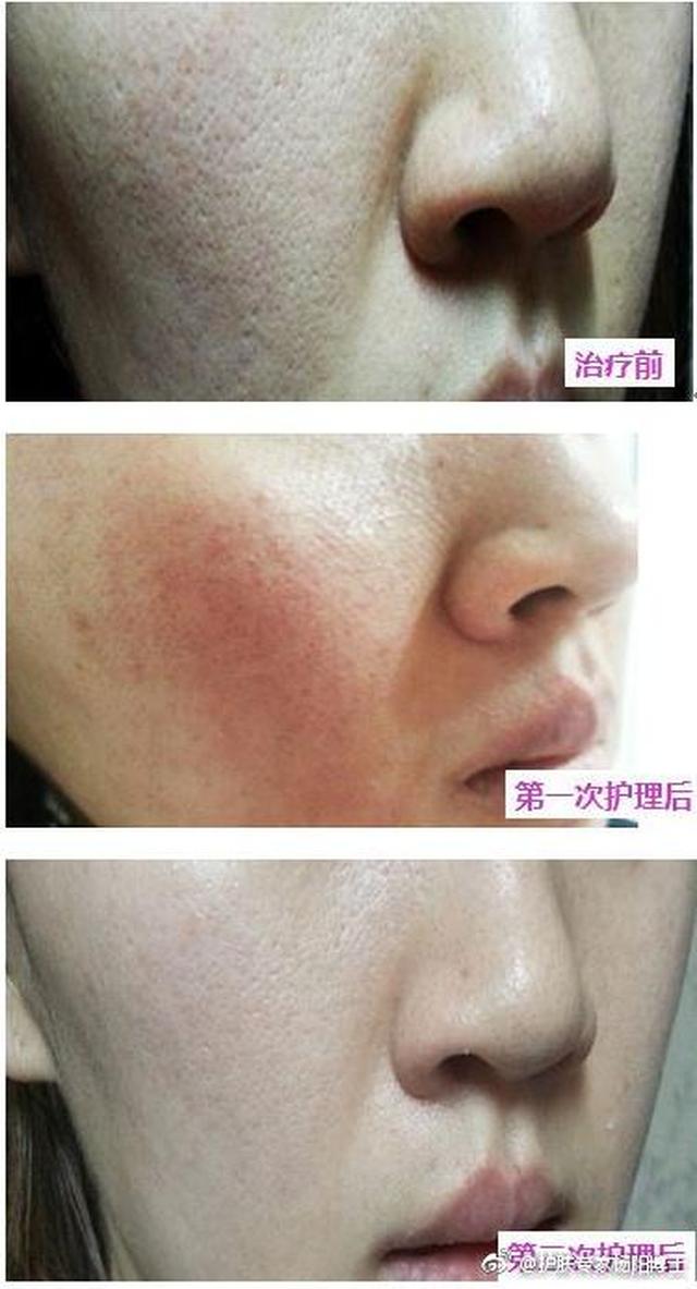 痤疮痘印痘坑不用怕飞梭镭射助你美肤嫩肤年轻10岁