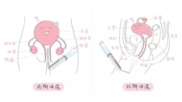 霉菌性阴道炎怎么治,霉菌性阴道炎怎么治疗好,孕妇霉菌性阴道炎怎么治