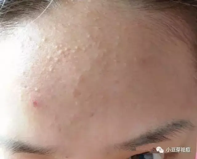 脸上这种封闭性的粉刺是不是快长成痘痘了?