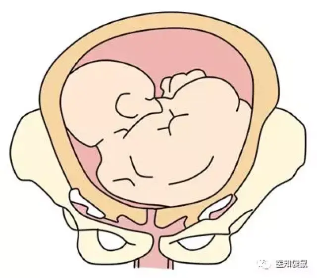 如果胎儿较小,骨盆够大,没有其他剖宫产指征,单臀位也可以阴道试产的