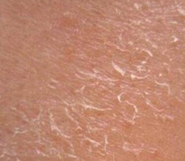 皮肤干燥起皮缺水,别用这4种护肤品,会致癌