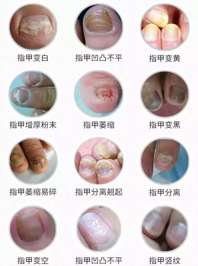 一般来说这些是常见的灰指甲的症状表现,大家可以根据症状对比一下