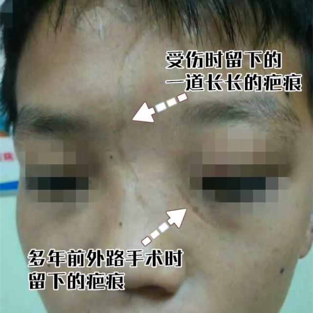 4岁遭遇车祸,9年来流泪不止!医生:这病易忽视!
