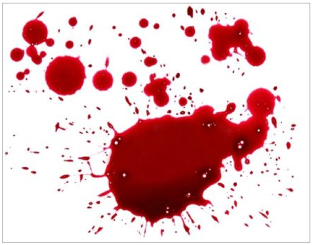 当人体消化道出血后,血液从肛门排出来,便血呈鲜红,暗红,血丝或柏油状