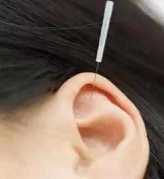3,耳针:取眼区敏感点,肝,肾,目1,目2,埋耳珠,用耳压法,每天按压耳珠2