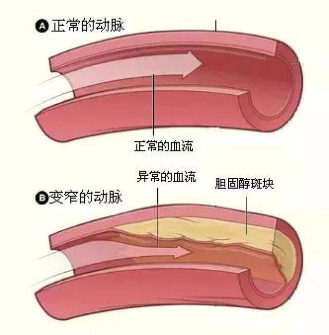 或够脚趾的过程中感到憋气,心慌等不适,说明动脉已硬化