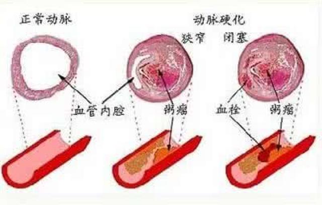 脑梗,心梗,动脉硬化都是因为这一个字!学会这三招,血管通畅人长寿