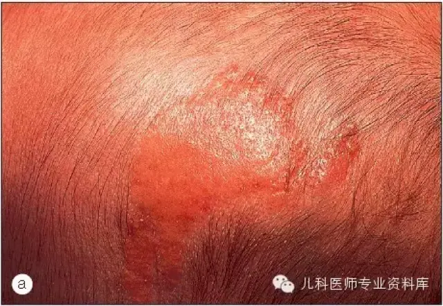 皮脂腺痣和幼年黄色肉芽肿