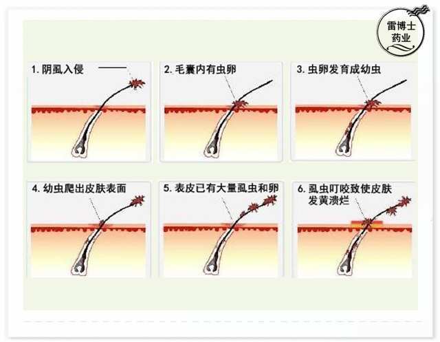 阴虱是一种寄生于人体毛发的寄生虫,是虱子的一种,产卵在人的阴毛根部