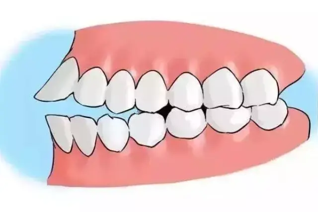 你知道什么是牙齿矫正吗?