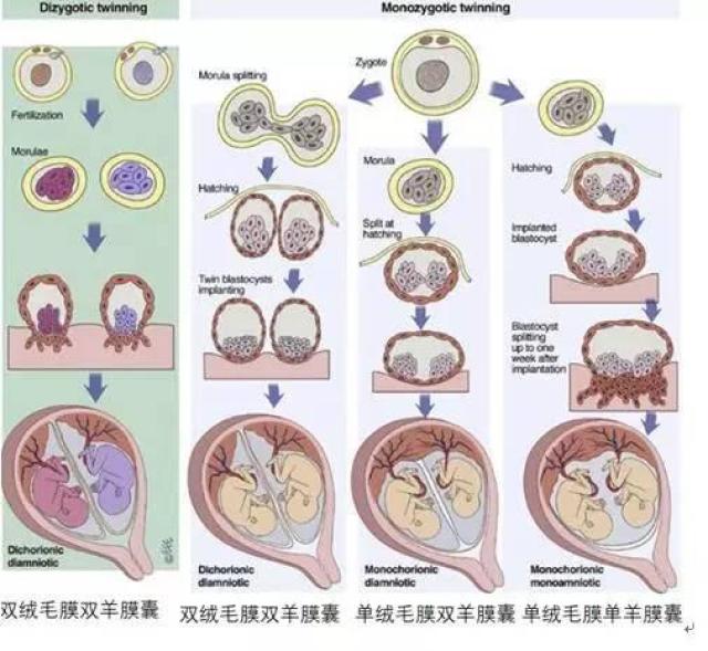 将双胎分为双绒毛膜双羊膜囊双胎,单绒毛膜双羊膜囊双胎及单绒毛膜单