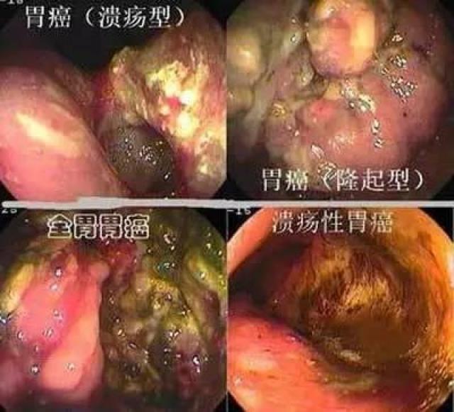 数月引发慢性浅表性胃炎,数年或数十年后发展成为十二指肠溃疡,胃溃疡