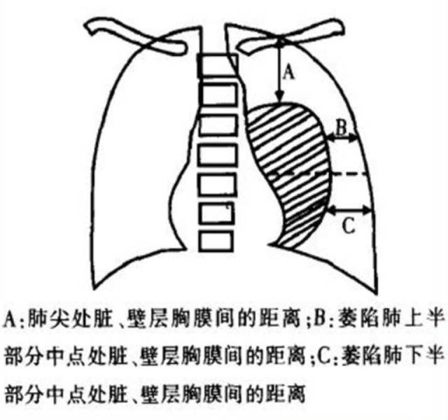 气胸程度花式算法,带你装x带你飞