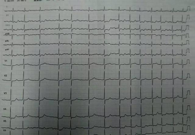 心电图:异位心率,心房颤动