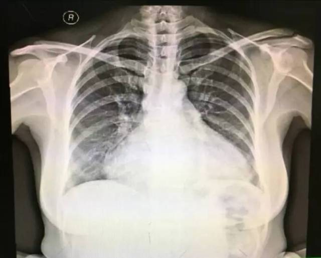 胸片:心影增大-考虑全心增大,考虑心包积液,心衰不除外;双肺,双膈未见
