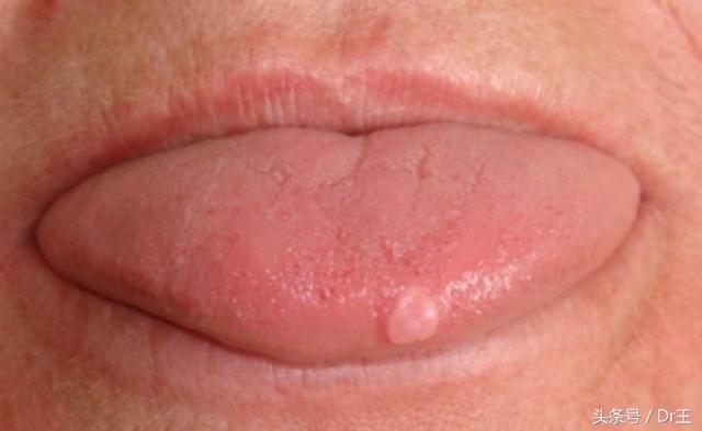 如果你习惯抽烟,那也有可能是白斑病的前兆 7.舌头鲜红色:你体内
