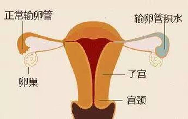 可能 会对生育造成哪些不良影响   不利于胚胎的正常发育:输卵管积水