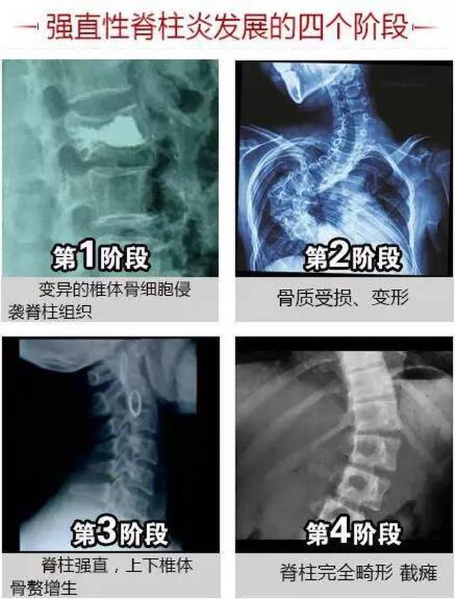 如何缓解强直性脊柱炎疼痛?不妨试试这些锻炼方法!