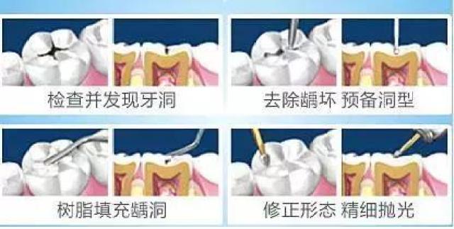 2, 中度龋齿的时候就需要通过补牙来及时治疗了,此时还没有伤及牙神经