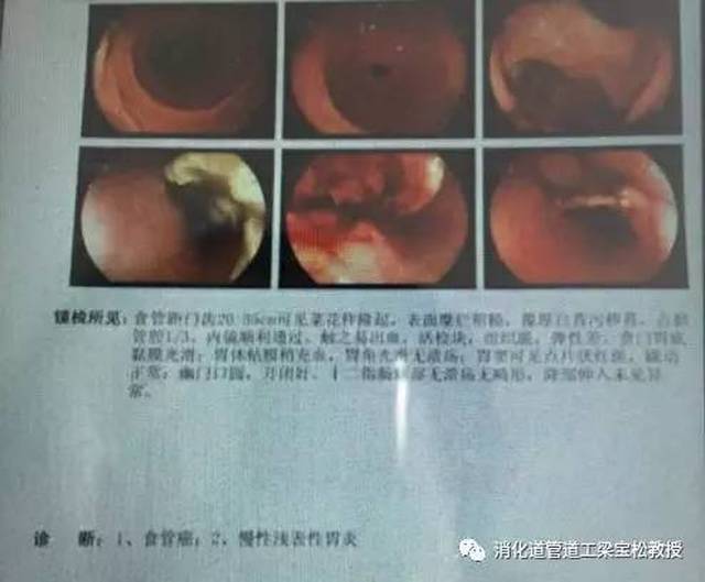 天呐!患者食管上段竟横挂着一根弯骨头