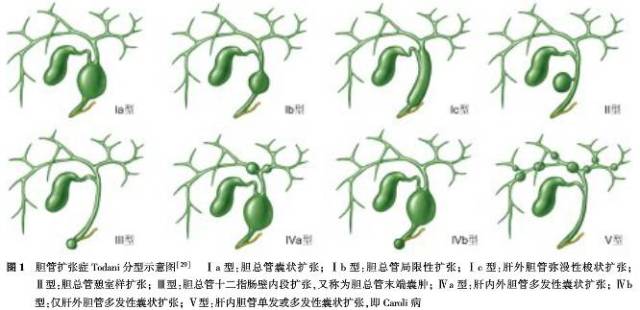 iii型为胆总管十二指肠壁内段扩张(占bd的4%),又称为胆总管末端囊肿.