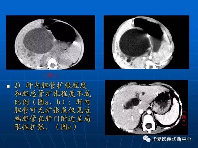 先天性胆管囊肿,该怎么分型?