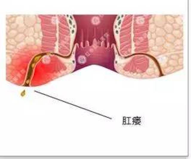 便血就是得了痔疮?还有6大原因!不骗你,3种方法查出真凶!