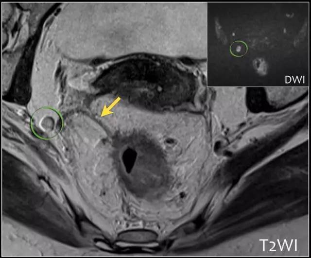 入门口诀:快速掌握直肠癌 mri 要领