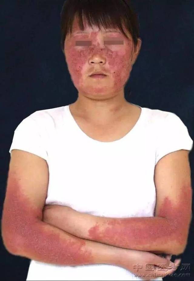 史上最全皮肤病彩色图谱, 吐血整理!收藏!转发!