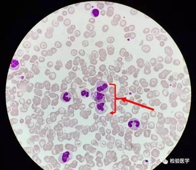 显微镜下白细胞分类为中性分叶核粒细胞64%,淋巴细胞3%,单核细胞7%,中