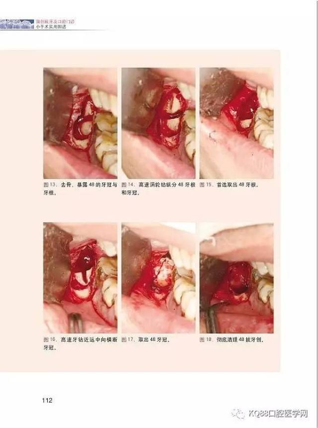 【即买即发】张东星新书《微创拔牙及口腔门诊小手术实用图谱》