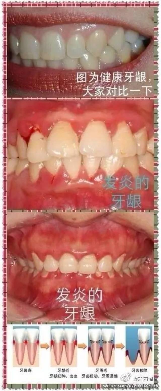 健康的牙龈,应该呈淡粉红色,有光泽,质坚韧,紧贴在牙齿 ..