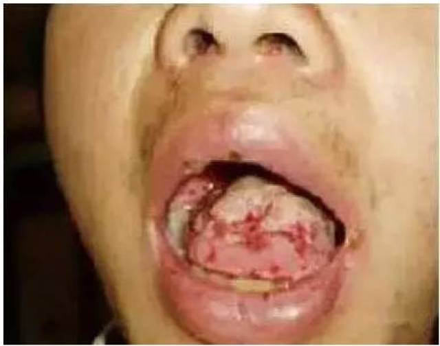 病变危害:口腔溃疡长期久治不愈,极有大概大抵口腔癌,对患者身段康健