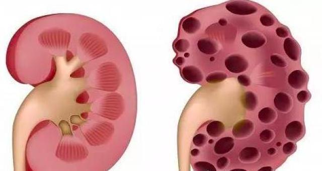 肾囊肿能不能通过核保 肾囊肿可以买重疾险吗