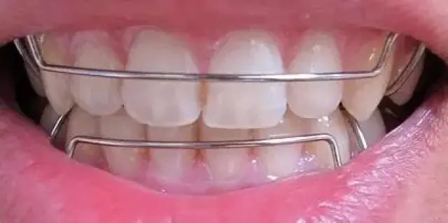 你以为摘了牙套就完事了?不戴好保持器搞不好分分钟前