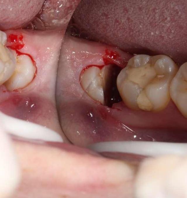 干槽症就是在拔牙之后牙槽一直处于一种干燥无血状态,造成伤口不愈合