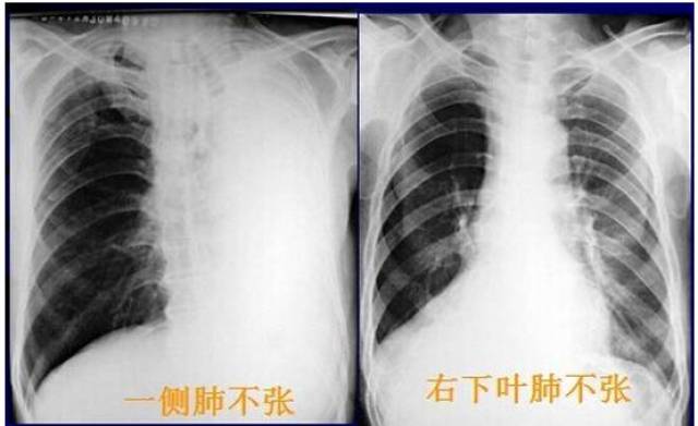 珍藏肺部常见病变的x线片总结