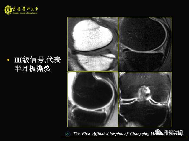 精彩幻灯:膝关节半月板 mri 入门,看这篇就够了!