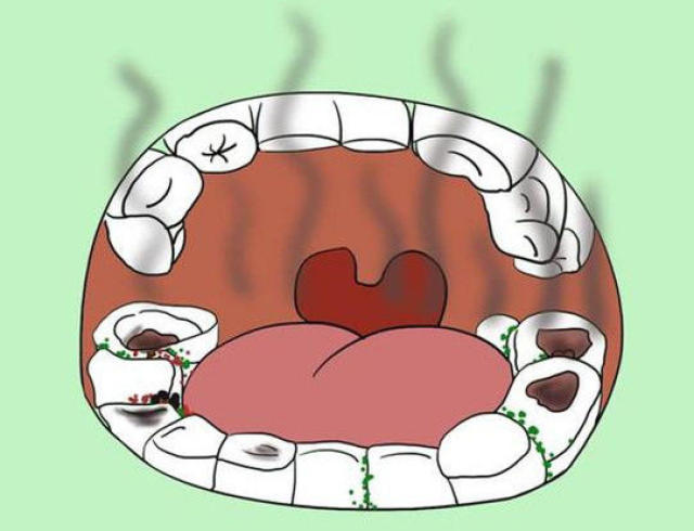 防治方法:找口腔医生检查食物嵌塞的原因,如果是牙齿