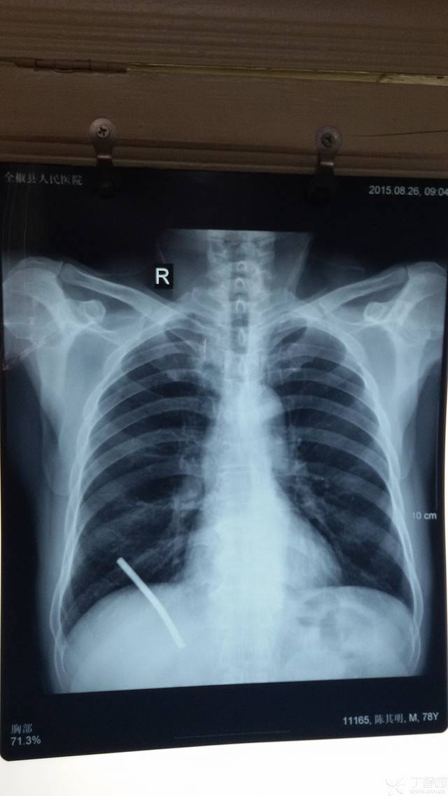 术后三年内固定物松动后跑到胸腔去了!这该如何治疗?
