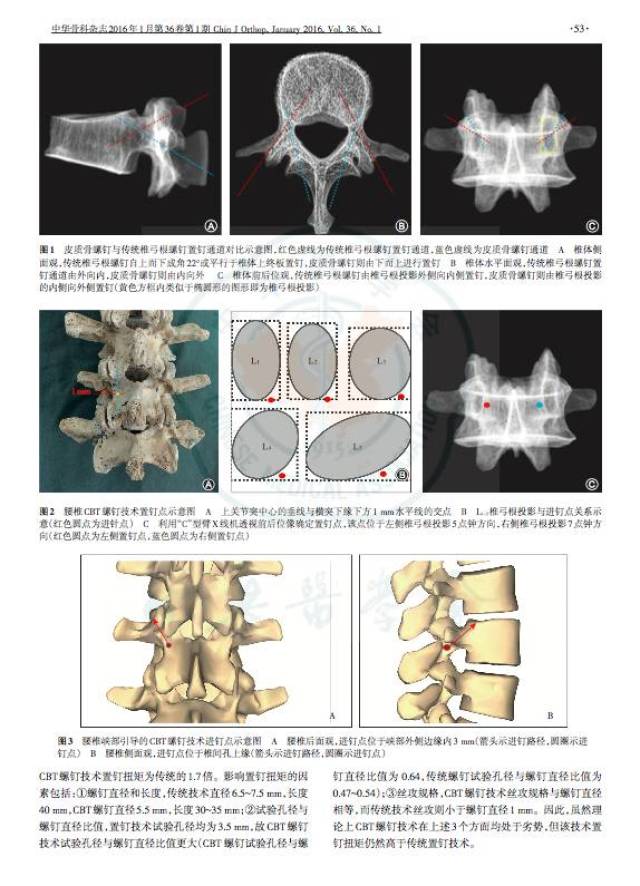 文献分享:皮质骨通道置椎弓根螺钉技术的研究进展