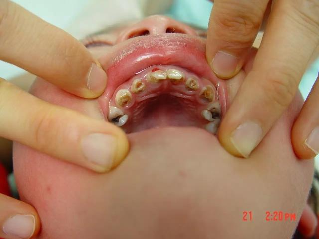 儿童乳牙龋齿有什么特点?